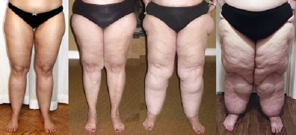lipedema